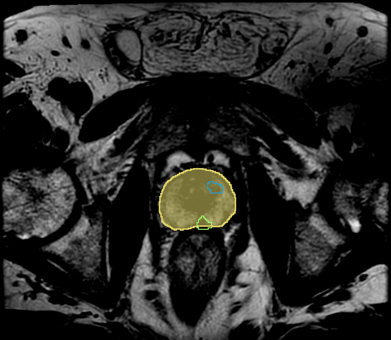 AI Assisted Prostate Segmentation, Lesion Contouring, and Reporting
